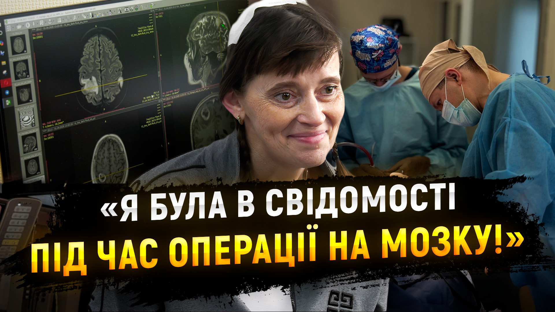 Дніпровські лікарі провели унікальну операцію на головному мозку пацієнтці у свідомості